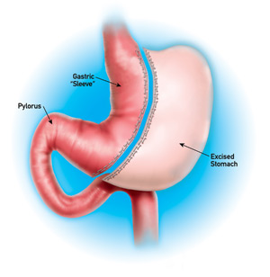 Vertical gastrectomy diagram