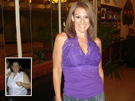 Maria, Before and After Bariatric Surgery