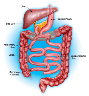 Duodenal switch surgery diagram
