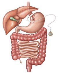 LAP-BAND System surgery diagram