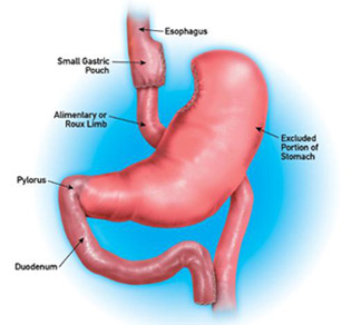 Roux-en-Y bypass surgery diagram